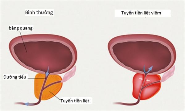 Chứng tiểu đêm, Phì đại tuyến tiền liệt- Nguyên nhân và cách điều trị