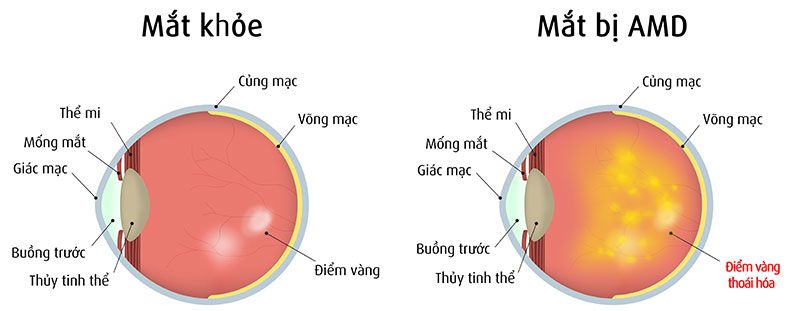 Có chữa khỏi thoái hóa điểm vàng không