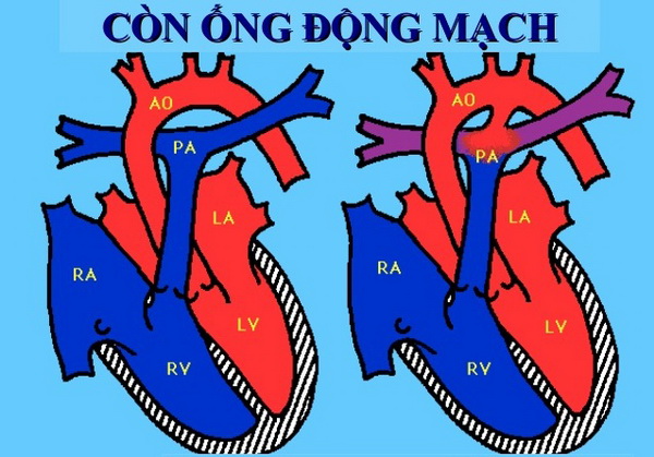 Còn ống động mạch chủ