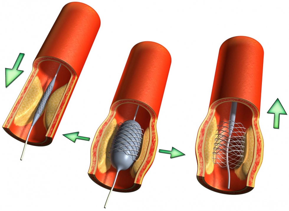 đặt stent mạch vành được bao lâu