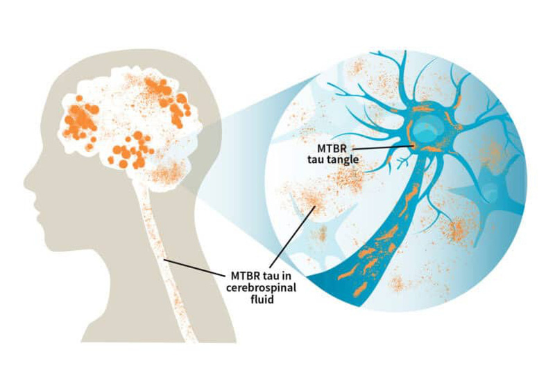 Dấu hiệu của bệnh Alzheimer và cách chăm sóc người bệnh