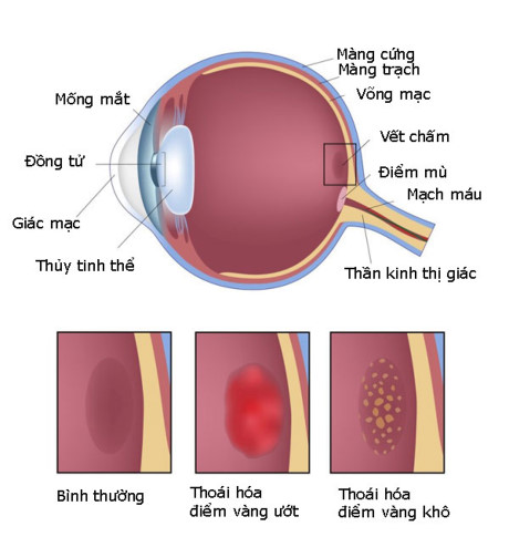 Dấu hiệu cuả bệnh thoái hóa điểm vàng là gì và cách phòng bệnh ra sao
