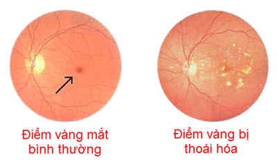 Dấu hiệu cuả bệnh thoái hóa điểm vàng là gì và cách phòng bệnh ra sao