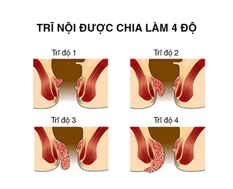 Dấu hiệu của bệnh trĩ nhẹ là gì và cách điều trị ra sao