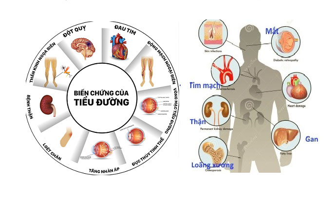 Dấu hiệu tiểu đường như thế nào và cách phòng bệnh ra sao