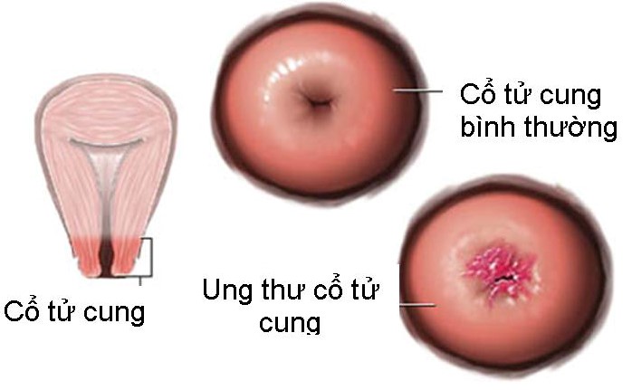 Dấu hiệu ung thư cổ tử cung giai đoạn cuối như thế nào