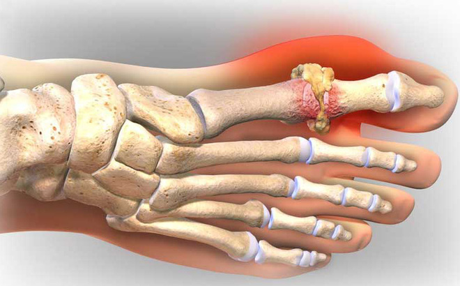Đau khớp ngón tay trỏ là gì và cách điều trị ra sao