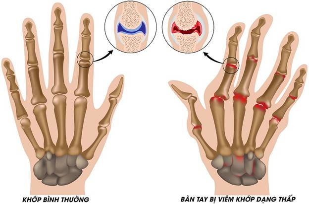 đau nhức trong xương là bệnh gì và cách chữa trị ra sao