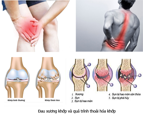 Sụn khớp bị tổn thương sẽ gây ra các bệnh về khớp