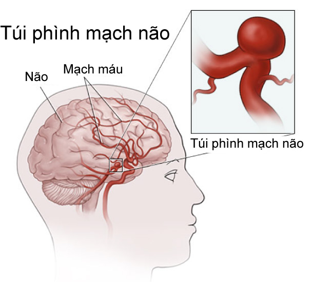 Di chứng tai biến mạch máu não là gì và cách phòng bệnh ra sao