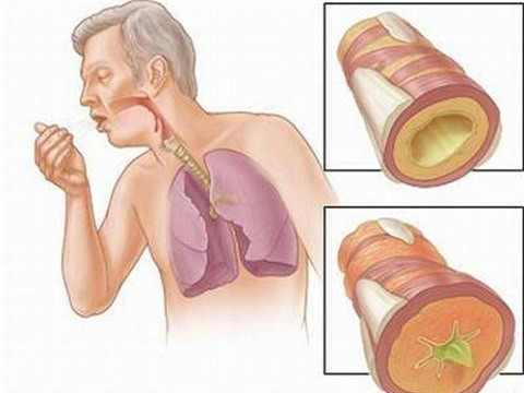 Diễn biến ung thư phổi giai đoạn cuối như thế nào