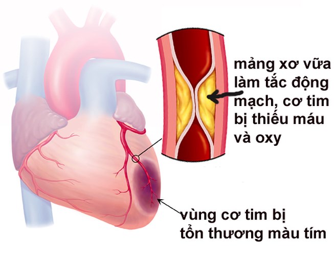 Điều trị nhồi máu cơ tim thành dưới an toàn hiệu quả