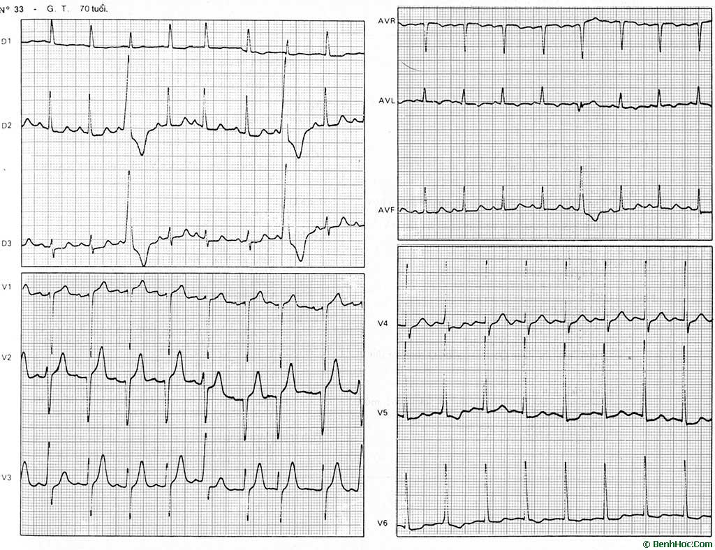 Điều trị nhồi máu cơ tim thành dưới an toàn hiệu quả