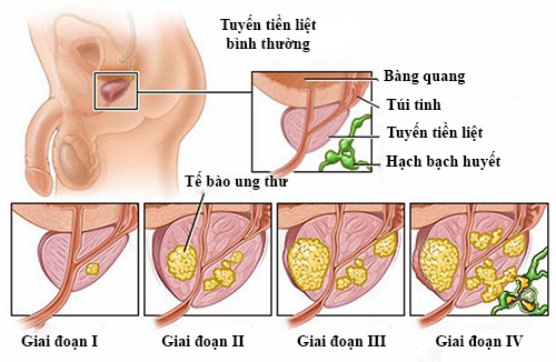 Điều trị ung thư tuyến tiền liệt bằng thuốc nam