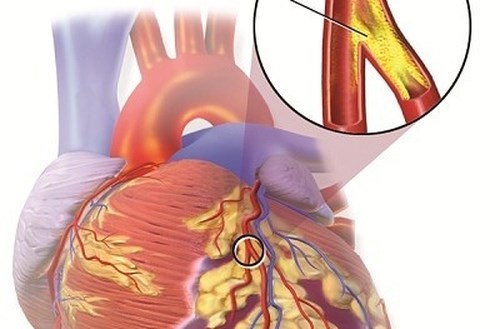 Dược thảo chống nhồi máu cơ tim, tai biến mạch máu não
