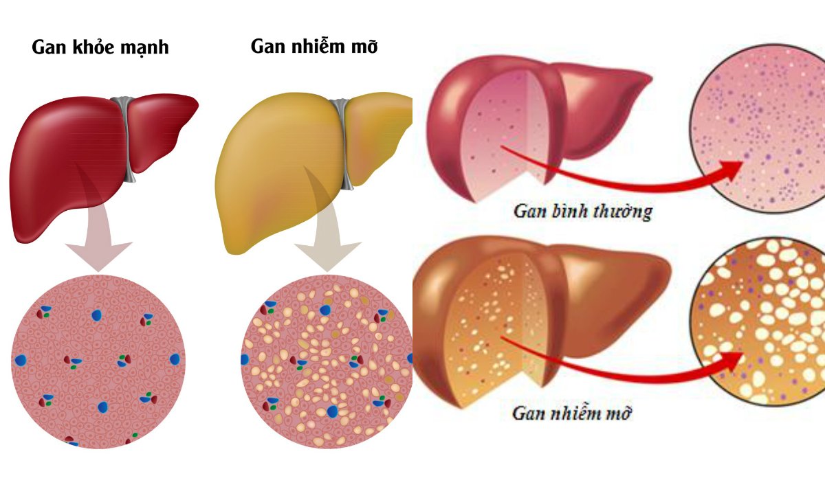 Gan nhiễm mỡ độ 2 kiêng gì tốt cho bệnh