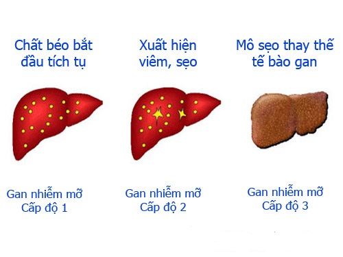 Gan nhiễm mỡ độ 2 nên ăn gì tốt an toàn