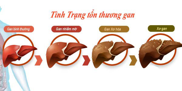 gan nhiễm mỡ