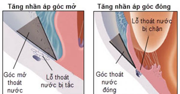 tăng nhãn áp góc đóng