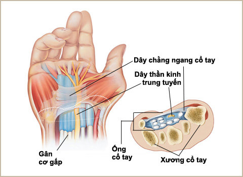 hiện tượng đau khớp cổ tay là bệnh gì và cách chữa trị