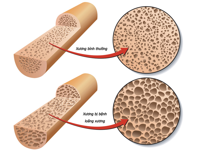 hiện tượng đau khớp cổ tay là bệnh gì và cách chữa trị