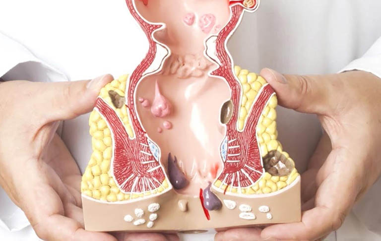Hướng dẫn thực hành lâm sàng để kiểm soát bệnh trĩ
