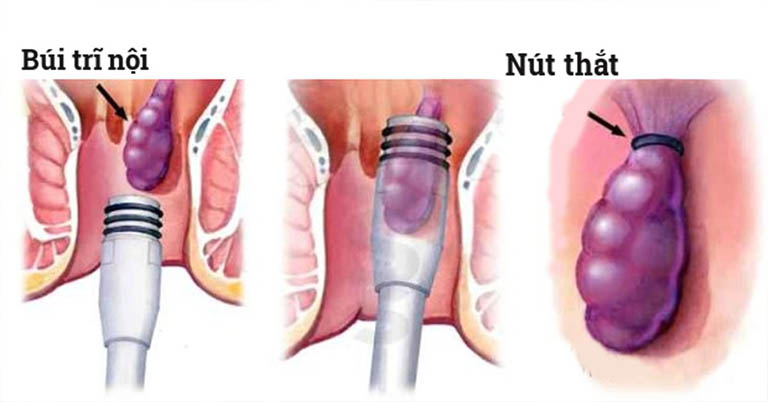 Hướng dẫn thực hành lâm sàng để kiểm soát bệnh trĩ