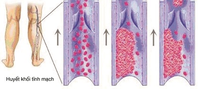 Cục máu đông và các biến chứng nguy hiểm