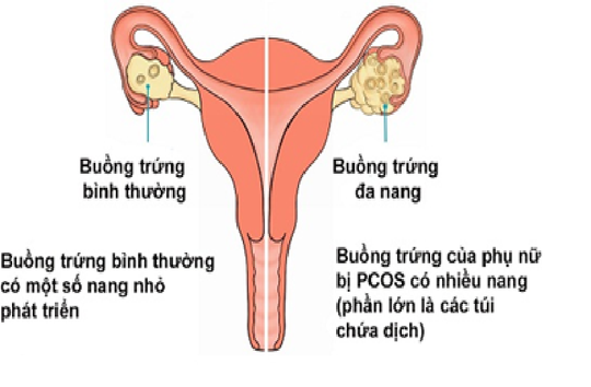 Không có kinh nguyệt 1 tháng có sao không