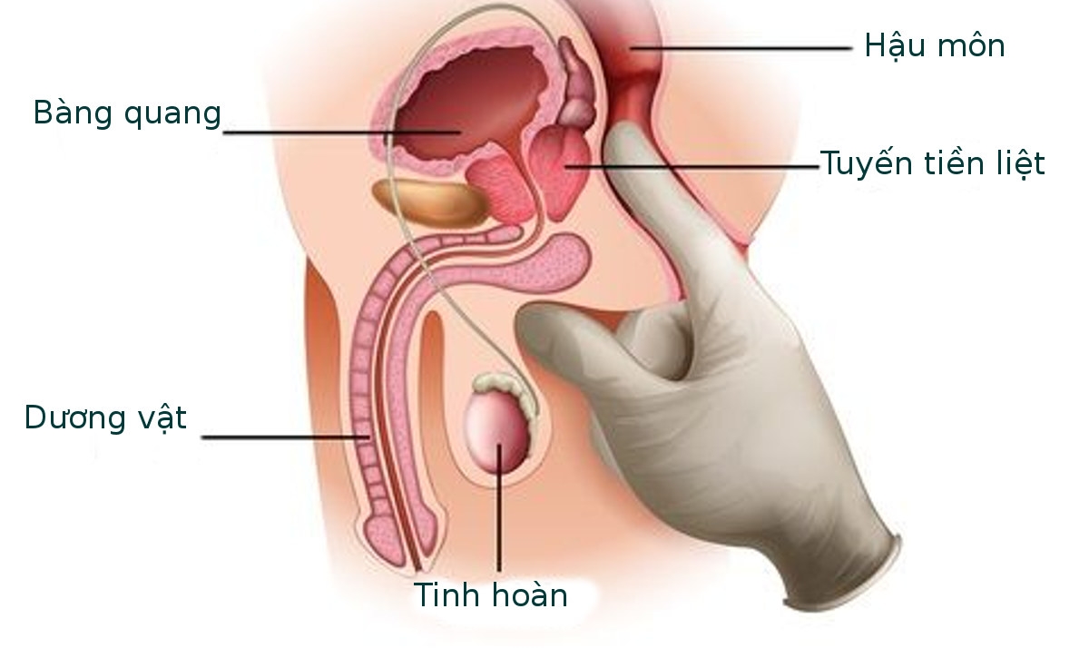 Kích thước phì đại tiền liệt tuyến như thế nào 
