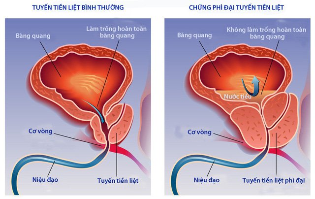 Kích thước tiền liệt tuyến bao nhiêu phải mổ 