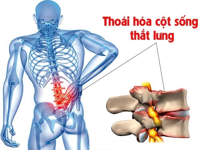 Làm gì khi bị thoái hóa đốt sống lưng