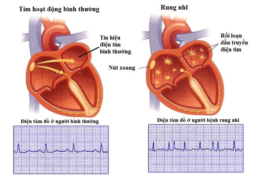Loạn nhịp tim có nguy hiểm không và cách chữa trị