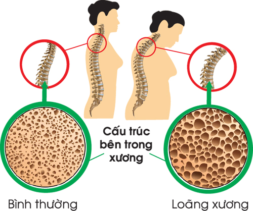 Đau nhức xương khớp, triệu chứng và các bệnh liên quan