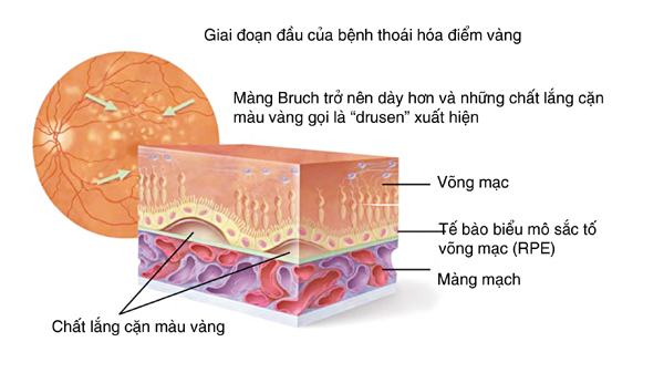 Mắt mờ uống thuốc gì hết