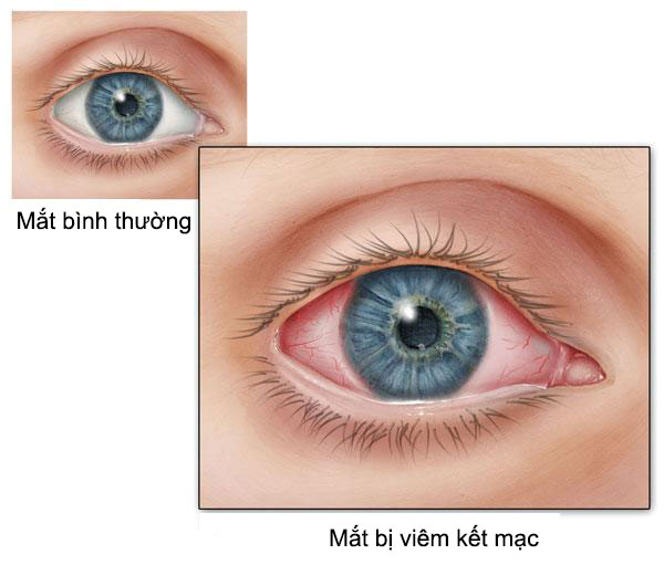 Mờ mắt nên uống thuốc gì hiệu quả an toàn