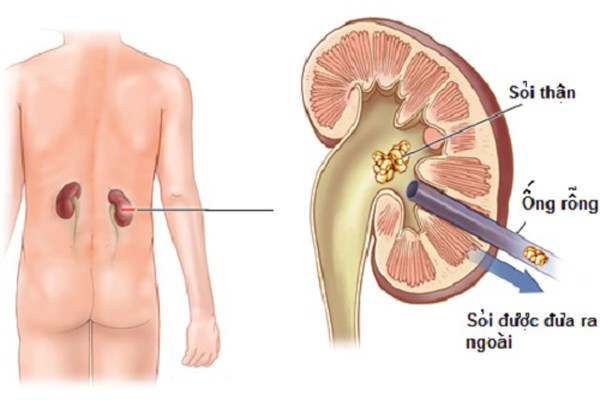 Mổ nội soi thận có đau không