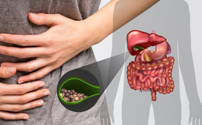 Mổ sỏi mật có ảnh hưởng gì không