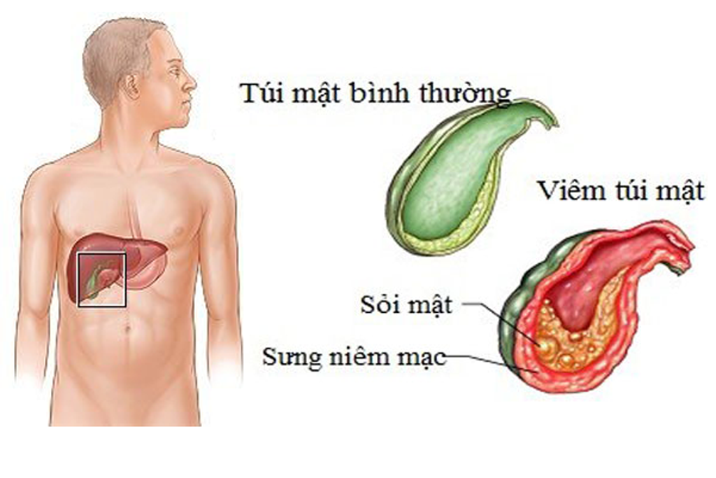 Mổ sỏi mật có ảnh hưởng gì không