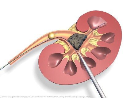 Mổ sỏi thận nên ăn gì an toàn hiệu quả