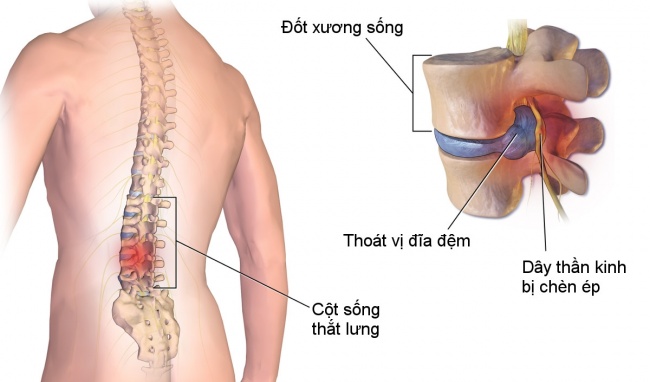 Nằm ngủ sai tư thế bị đau lưng có sao không