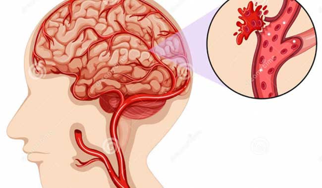 Ngăn chặn nguy cơ nhồi máu cơ tim và tai biến mạch máu não