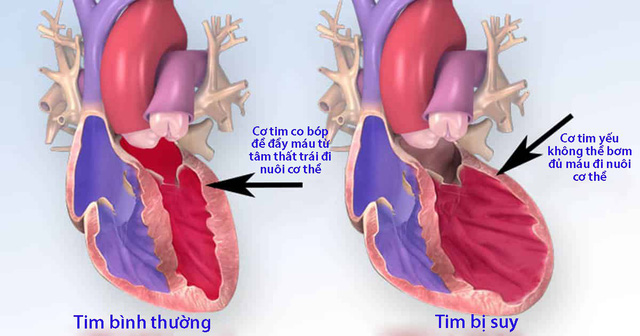 Người bệnh mạch vành dễ bị tai biến 