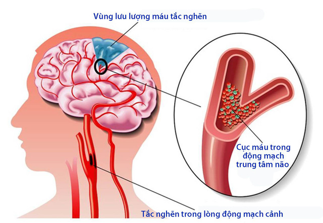 Người bệnh mạch vành dễ bị tai biến