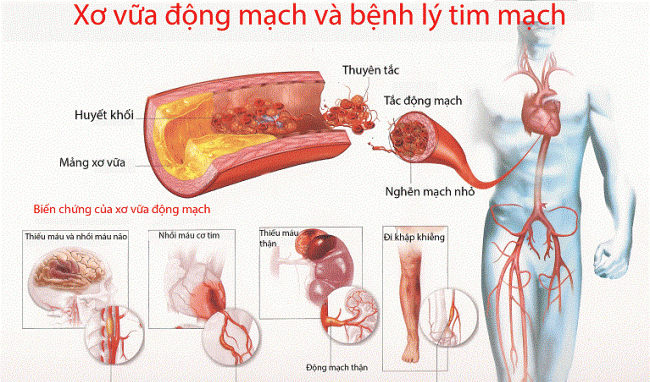 Người bị bệnh tim nên uống sữa gì tốt cho bệnh