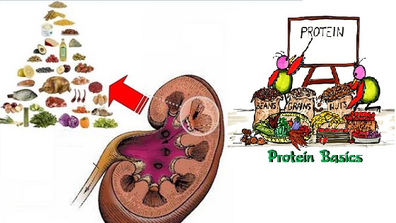 Người bị sỏi thận nên kiêng ăn gì tốt cho bệnh