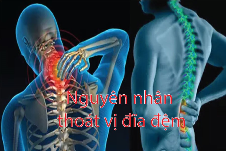 Người bị thoát vị đĩa đệm nên uống sữa gì