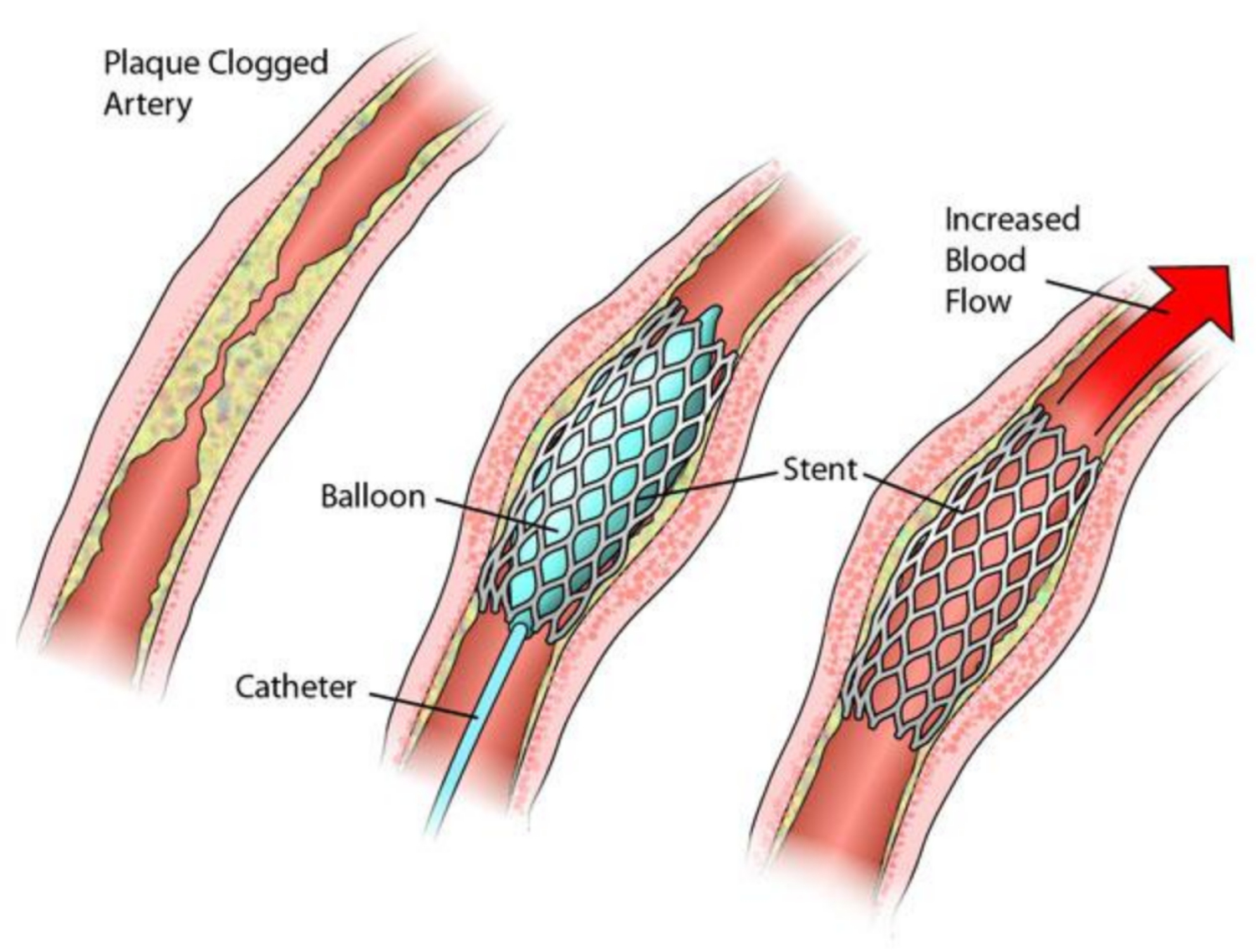 Người đặt stent mạch vành không nên ăn gì tốt cho bệnh