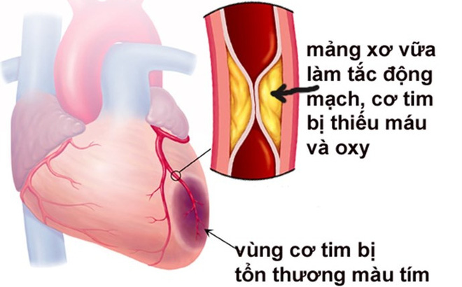 Nguyên nhân của nhồi máu cơ tim là gì và cách phòng bệnh ra sao