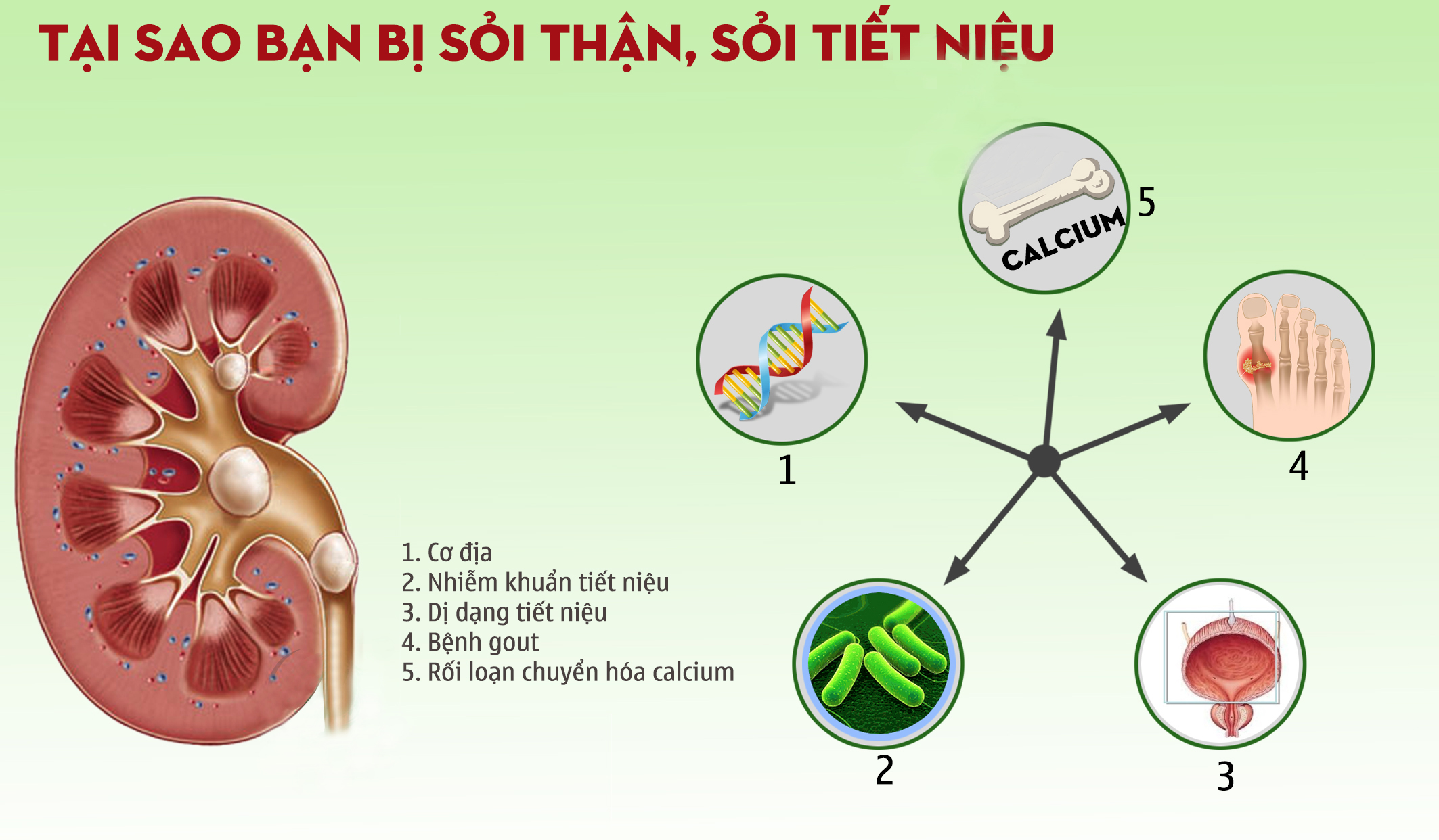 Thuốc điều trị bệnh sỏi thận an toàn và hiệu quả nhất